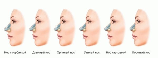 Наиболее распространенные типы носа