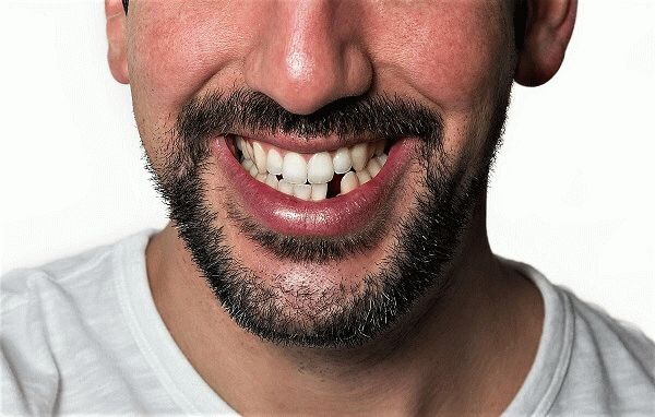 Можете ли вы классифицировать войска с плохими зубами?